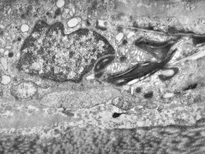 M,3y. | globoid leukodystrophy of Krabbe - n.suralis